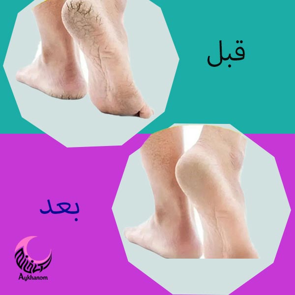 جوراب سیلیکونی ضد ترک پا - تصویر 2