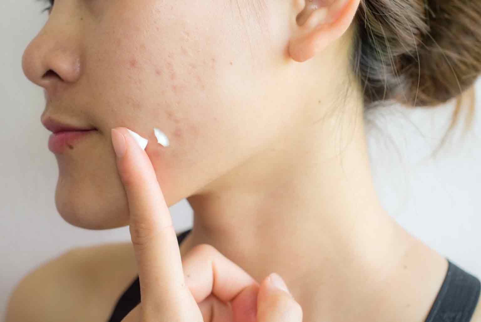 همه چیز درباره سرم سالیسیلیک اسید: معجزهای برای پوستهای مستعد جوش فروشگاه اینترنتی آی خانمی