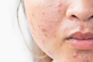 راه‌حل مؤثر برای پوست‌های جوش‌دار: سرم ضد جوش و جای جوش فروشگاه اینترنتی آی خانمی