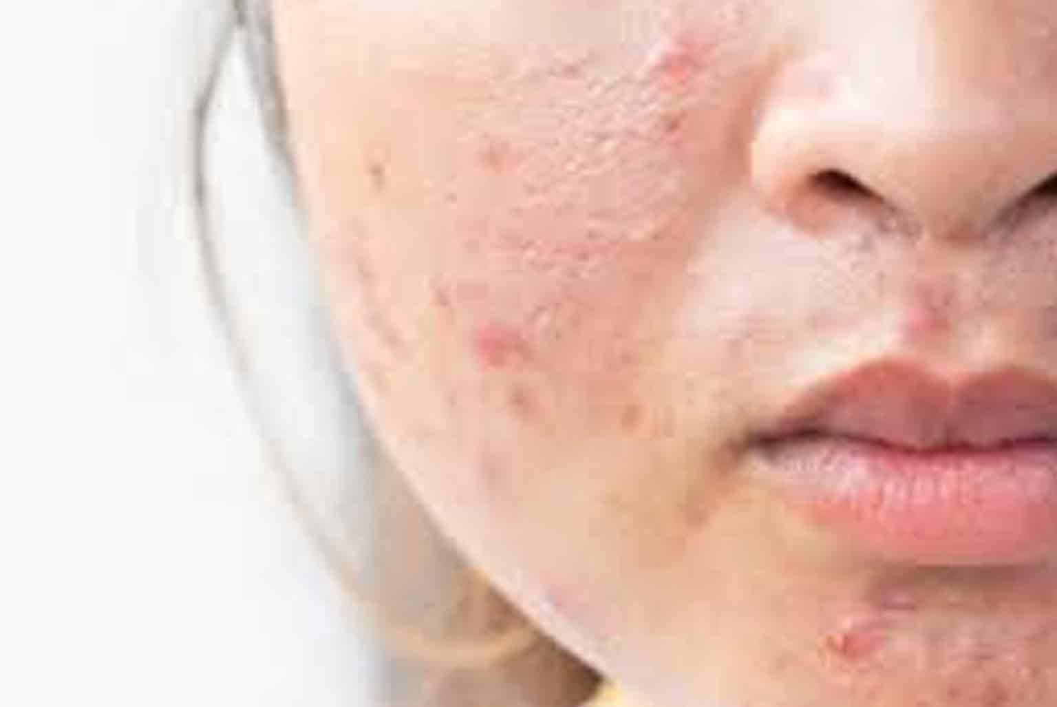 راه‌حل مؤثر برای پوست‌های جوش‌دار: سرم ضد جوش و جای جوش فروشگاه اینترنتی آی خانمی